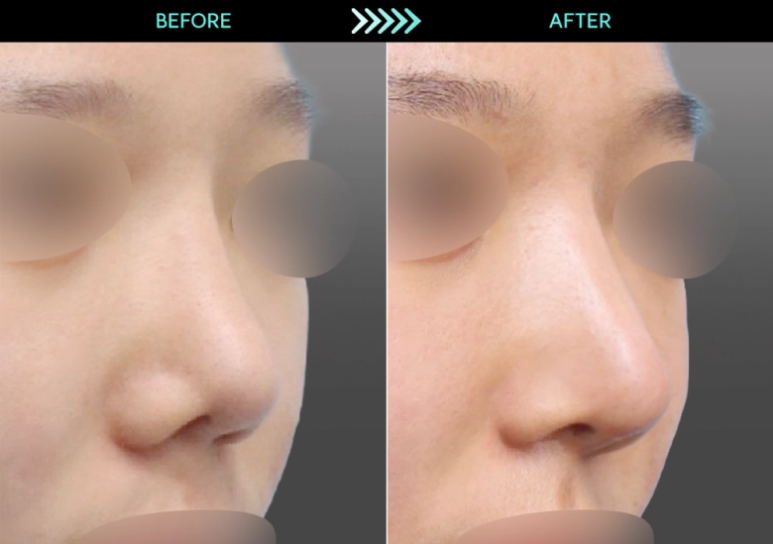 [Revision Rhinoplasty] 2 Months After Bulbous Nose Correction: The Standard Approach to Bulbous Nose and Short Nose Correction image 2
