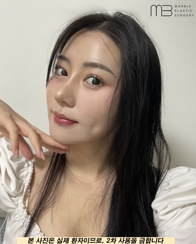 자연유착쌍꺼풀후기 눈매를 더욱 또렷하게 관련 이미지 5