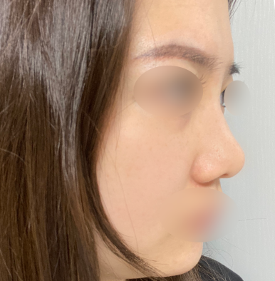 [Gangnam Plastic Surgery Revision Rhinoplasty Review] My bulbous nose showed no improvement at all… I found the nose shape I’ve always wanted after meeting Dr. Junhyung Kim haha image 4