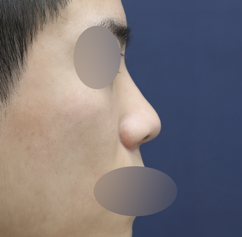Improving Your Impression Before and After Male Rhinoplasty image 2