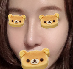 [강남역성형외과 매부리코수술 후기] 코재수술이라 진짜 무서웠는데 매부리코, 복코교정 한번에 해결 됐어요! 관련 이미지 6