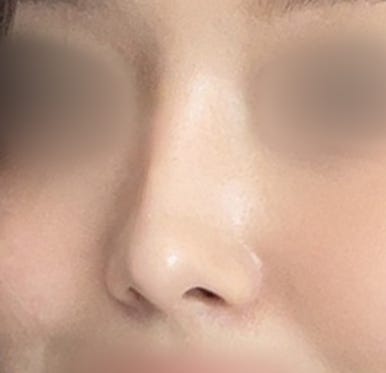 [Gangnam Plastic Surgery Clinic Rhinoplasty Revision Review] No matter how many surgeries I had, my nose still looked flat and wide... Now it has finally settled into a beautiful shape haha image 7