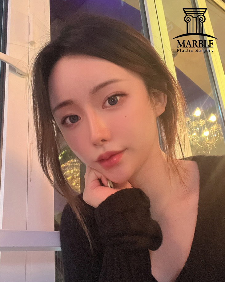 눈재수술, 반복되지 않으려면 마블성형외과의원에서! 관련 이미지 3