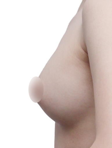 가슴재수술, 실패를 줄이기 위한 기준은? 관련 이미지 2