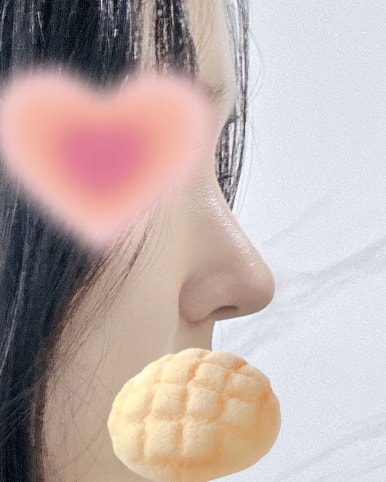 [강남역 성형외과 코수술 후기] 김준형 원장님 덕분에무보형물로 코끝교정 성공! 예쁜 직반 라인 얻었어요ㅎㅎ 관련 이미지 5