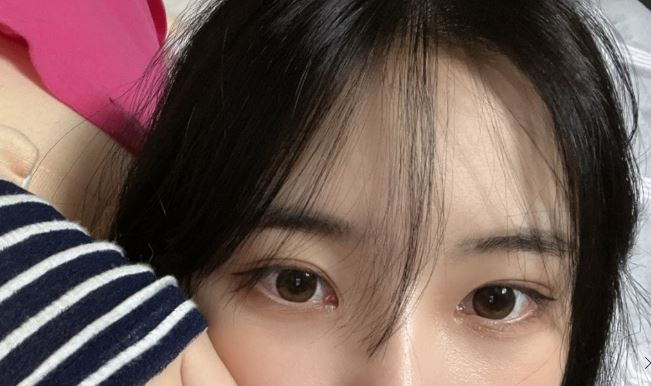 쌍꺼풀 수술후 관리할때 꼭 알아야할것들 관련 이미지 2