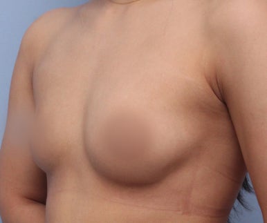 [가슴확대수술 잘하는 곳 마블성형외과 후기] 윗가슴이 없어서 나시 입을 때마다 텅 비어 보이던 과거..ㅠㅠ 관련 이미지 5