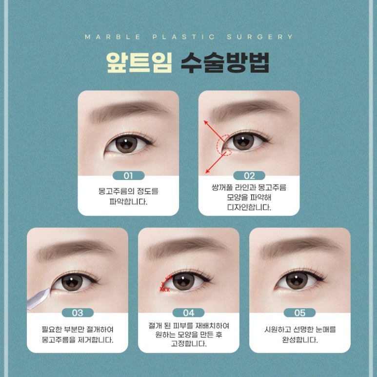 눈트임성형, 답답한 눈에서 시원한 눈매로 관련 이미지 4
