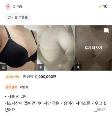 [강남성형외과 가슴수술 후기] 짝가슴때문에 스트레스였는데ㅠㅠ 양쪽 볼륨 딱 맞춰지고 핏이 달라졌어요! 관련 이미지 1