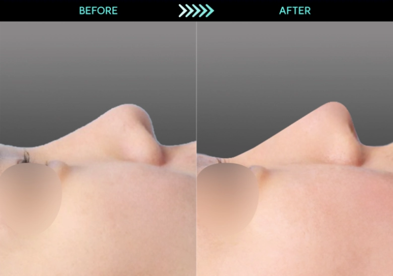 [Revision Rhinoplasty] 2 Months After Bulbous Nose Correction: The Standard Approach to Bulbous Nose and Short Nose Correction image 4