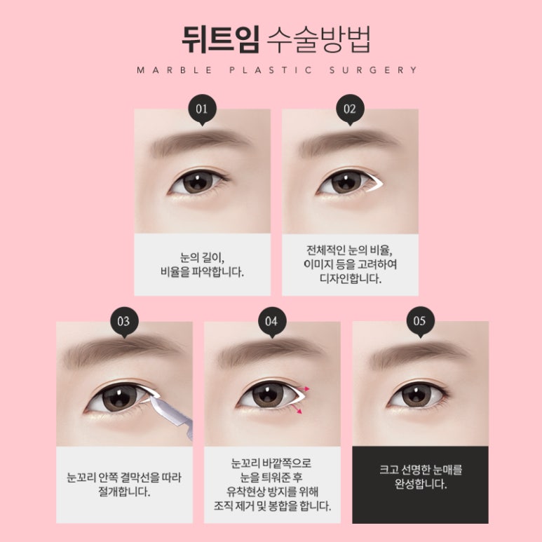 뒤트임후기 흉터 걱정 최소화하기 위해서 관련 이미지 7