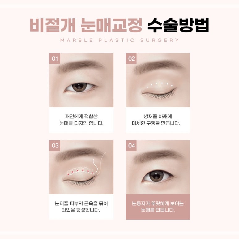 눈성형잘하는곳의 수술과 눈매교정에 대하여 관련 이미지 5