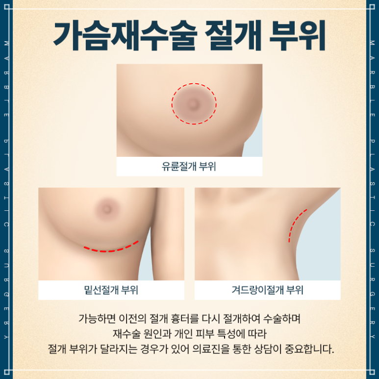 모티바가슴재수술 만족도 높은 강남성형외과 찾는다면｜마블성형외과의원 관련 이미지 12