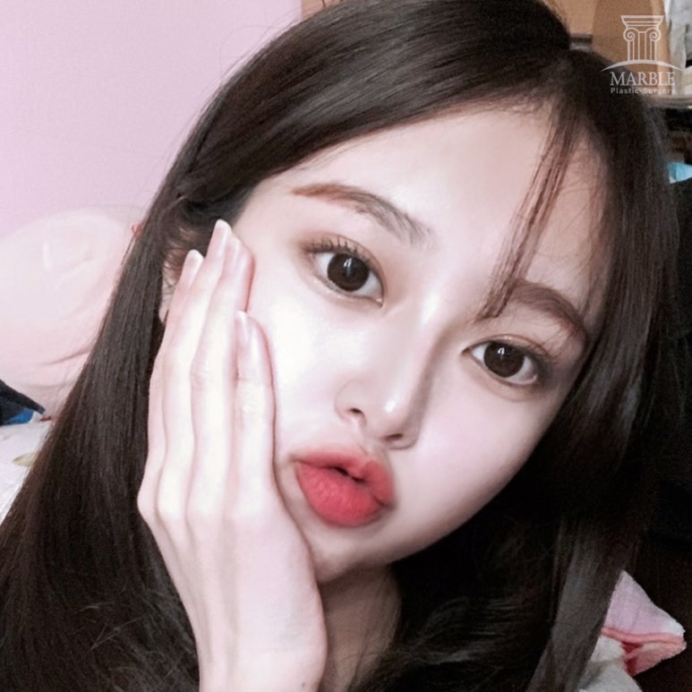 눈매교정가격 개인의 눈 상태에 따라서 관련 이미지 2