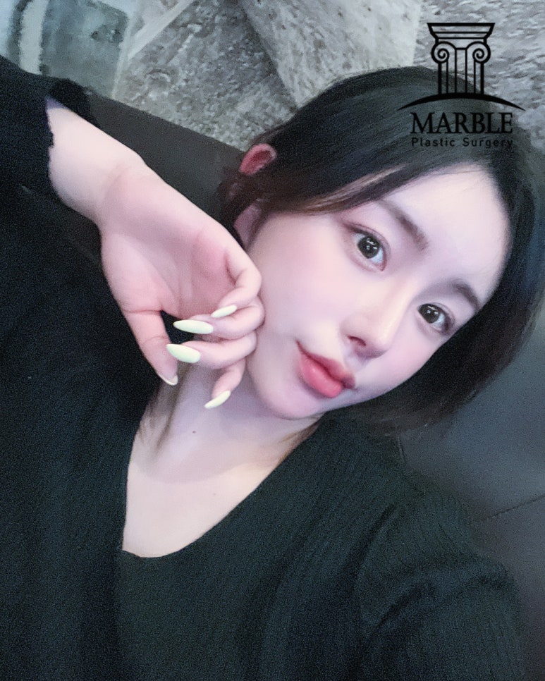 눈재수술, 반복되지 않으려면 마블성형외과의원에서! 관련 이미지 7