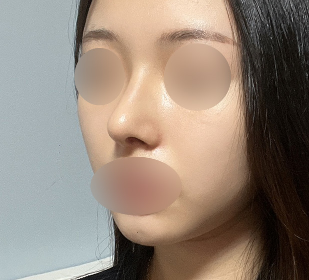Hump Nose Surgery Is Not Simply a Procedure to Shave It Down. image 8