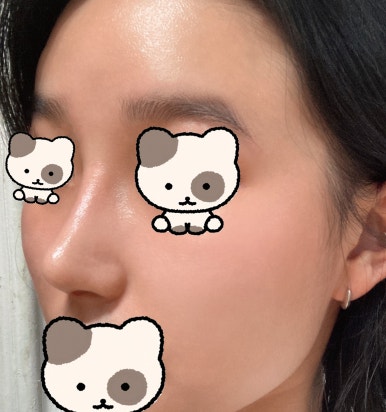 [Gangnam Station Plastic Surgery Hump Nose Surgery Review] I Escaped the Hump That Fillers Couldn’t Fix! It Looks Prettier with a Slim, Straight Line Haha image 8