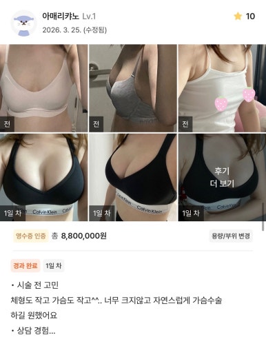 [Real Breast Augmentation Review] I used to be unable to even go out without a padded bra, and I’m so happy I finally escaped that tiny bust! image 1