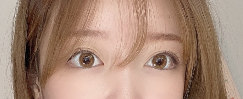 뒤트임후기 흉터 걱정 최소화하기 위해서 관련 이미지 1