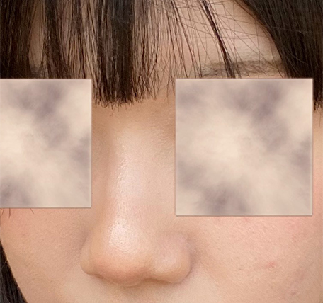 [Gangnam Plastic Surgery Hump Nose Surgery Review] The Bulky, Humped Nose That Looked Thick... A Refined Impression Achieved Without an Implant, haha image 4