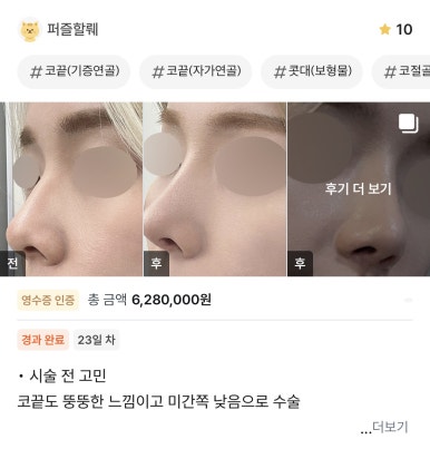[Gangnam Plastic Surgery Clinic Hump Nose Surgery Review] Worried It Might Look Unnatural, I Hesitated About My Hump Nose… Adding Bulbous Nose Correction Helped Me Settle on My Perfect Nose Line! image 1