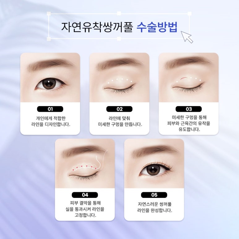 눈성형외과유명한곳, 눈 병원을 찾는다면 관련 이미지 7