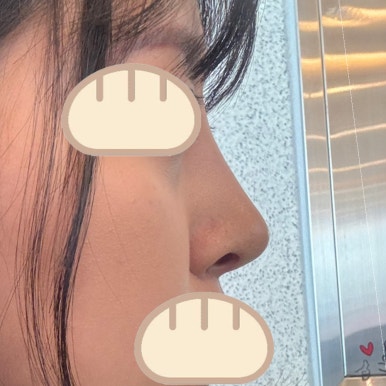 [강남성형외과 복코성형 후기] 보정하기 바빴던 펑퍼짐한 복코.. 얼굴 밸런스에 맞게 바꿔주셨어요! 관련 이미지 6