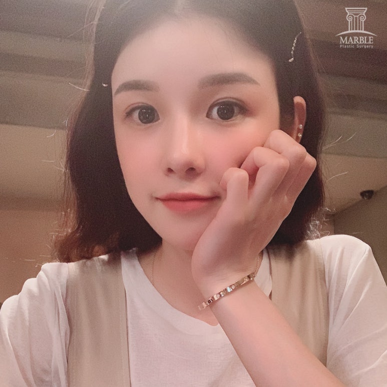 눈재수술비용 알아보고 있다면 관련 이미지 7