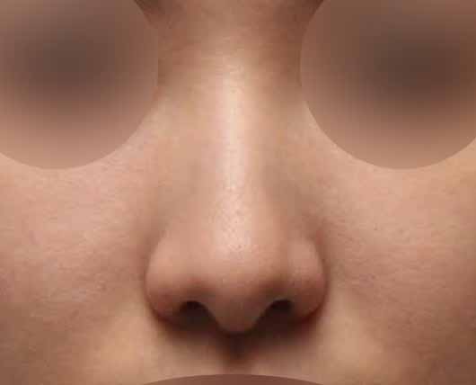 매부리코수술 전후 공개, 과하지 않게 교정한 리얼 경험 관련 이미지 1