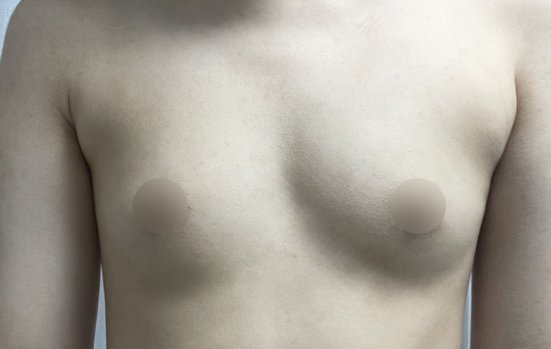 One-Month Real Review After Breast Augmentation ｜ From Right After Surgery to the Changes Over Time image 1