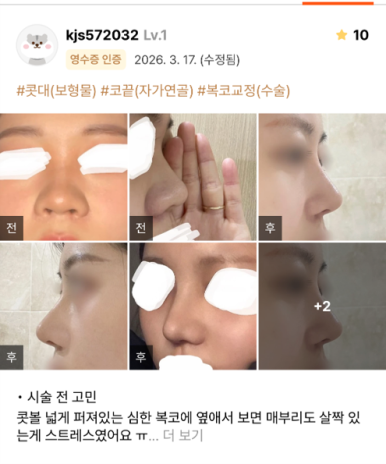 [마블성형외과 코수술 후기] 퍼진 복코에 매부리까지.. 인상 강해 보여서 거울 보기 싫었던 과거 탈출ㅠㅠ 관련 이미지 1