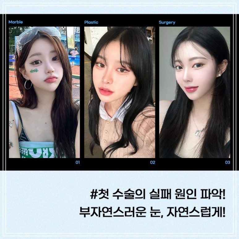 쌍수재수술잘하는곳 비용보다 원인분석이 중요 관련 이미지 4