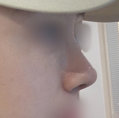 [Gangnam Plastic Surgery Bulbous Nose Surgery Review] I Was Stressed About My Nose Filler Spreading... but the Natural-Looking Straight-Line Profile Was a Huge Success! Haha image 5