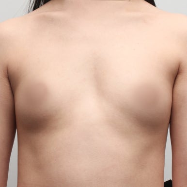 [강남역 성형외과 가슴성형 후기] 빈약한 윗가슴 콤플렉스..짝가슴도 맞춰졌고 촉감까지 완전 찐가슴이에요! 관련 이미지 3