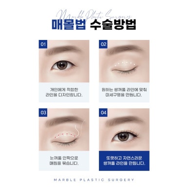 눈성형잘하는병원, 쌍꺼풀수술, 트임수술 관하여 관련 이미지 6