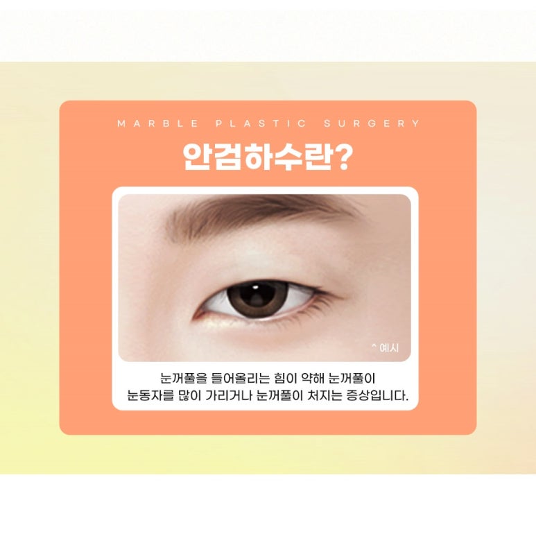 남자눈매교정가격, 잘 알아보고 결정 관련 이미지 3