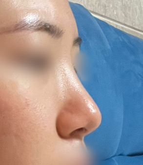 [마블성형외과 코성형 후기] 코수술 한 티도 안 나던 뭉툭한 복코... 재수술로 드디어 정착했어요ㅠㅠ 관련 이미지 3