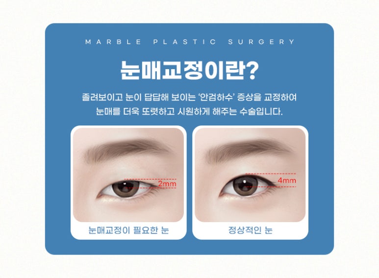 강남눈매교정 더 또렷하게 마블성형외과의원 관련 이미지 2