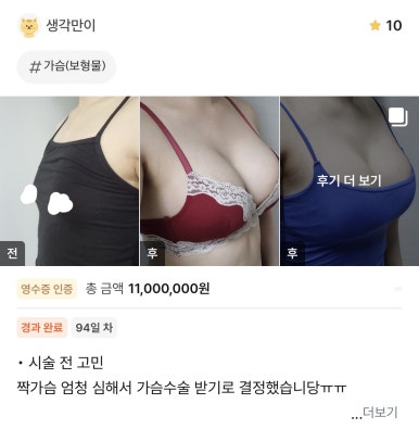 [강남역 성형외과 가슴수술 후기] 나만 알던 짝가슴 스트레스ㅠㅠ 서일범 원장님 만나고 완벽 대칭 성공ㅎㅎ 관련 이미지 1