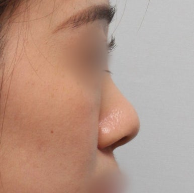 [Gangnam Plastic Surgery Bulbous Nose Surgery Review] I Was Stressed About My Nose Filler Spreading... but the Natural-Looking Straight-Line Profile Was a Huge Success! Haha image 4