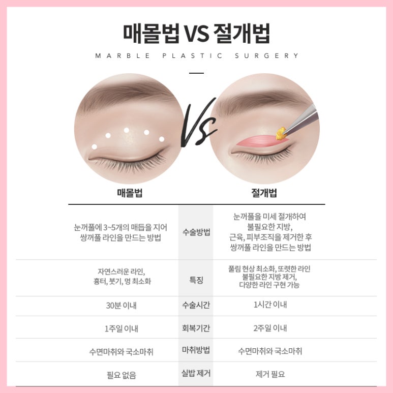 쌍꺼풀매몰후기 찾아보고 있다면 관련 이미지 6