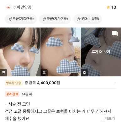 [강남역 성형외과 코재수술 후기] 얇은 코 고민 탈출! 원장님 디테일 덕분에 자려한 코 완성했어요ㅎㅎ 관련 이미지 1