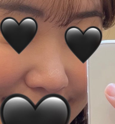 [Gangnam Plastic Surgery Rhinoplasty Review] I Was Worried About My Bulbous Nose.. It Turned Out Beautiful While Healing Well Without Inflammation or Side Effects hehe image 5