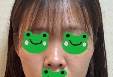 [Gangnam Plastic Surgery Rhinoplasty Review] My Short Nose Looked Upturned from the Front… Now It Has the Perfect Line with Postoperative Care Too! image 3