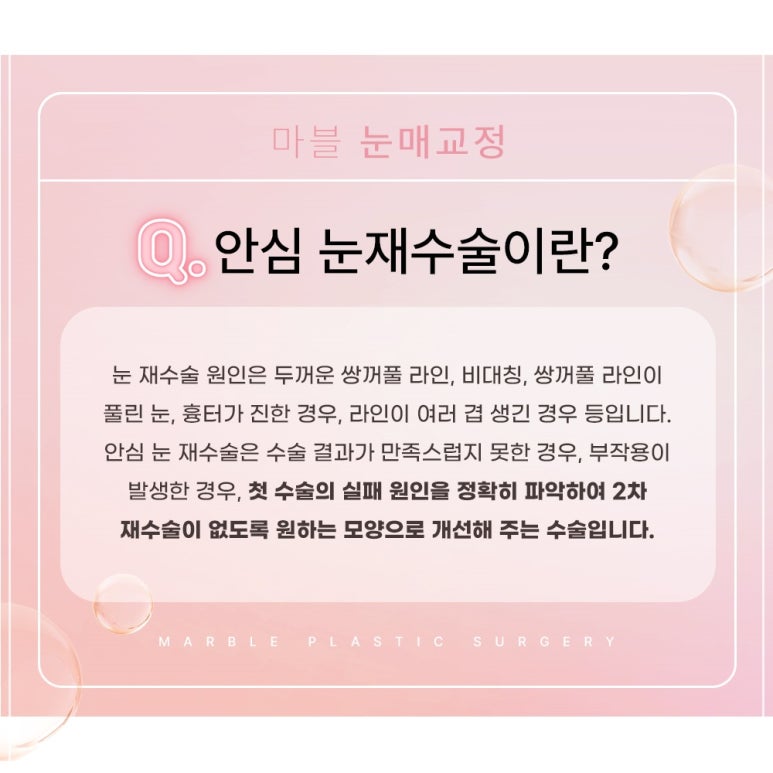 쌍수 눈재수술잘하는곳의 쌍꺼풀재수술 : 안전성, 심미적 측면, 비용 가격 등 관련 이미지 2