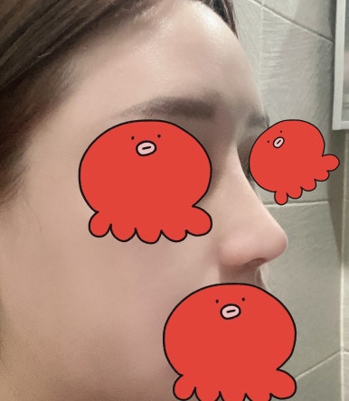 [강남성형외과 매부리코성형 후기] 부작용만 찾다가,, 금손 원장님 만나 코 정착했어요! 관련 이미지 8