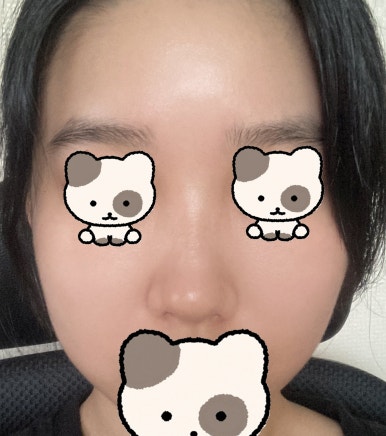 [Gangnam Station Plastic Surgery Hump Nose Surgery Review] I Escaped the Hump That Fillers Couldn’t Fix! It Looks Prettier with a Slim, Straight Line Haha image 4