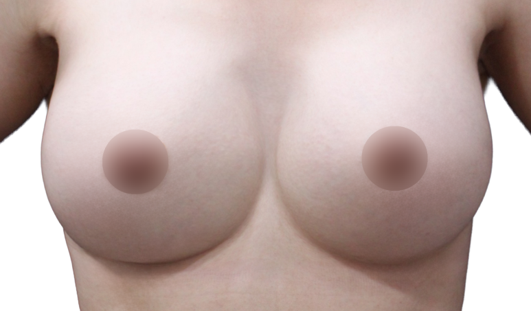 가슴재수술, 실패를 줄이기 위한 기준은? 관련 이미지 10