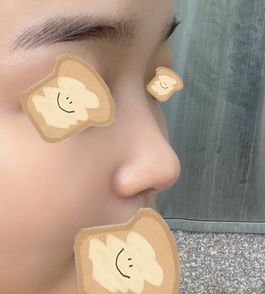 [Gangnam Station Plastic Surgery Nose Revision Review] A Tearful 4th Revision Marked by Failure... I Met Dr. Kim Jun-hyung and Succeeded! image 3