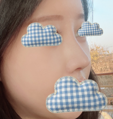 [강남역 성형외과 코재수술 후기] 얇은 코 고민 탈출! 원장님 디테일 덕분에 자려한 코 완성했어요ㅎㅎ 관련 이미지 5